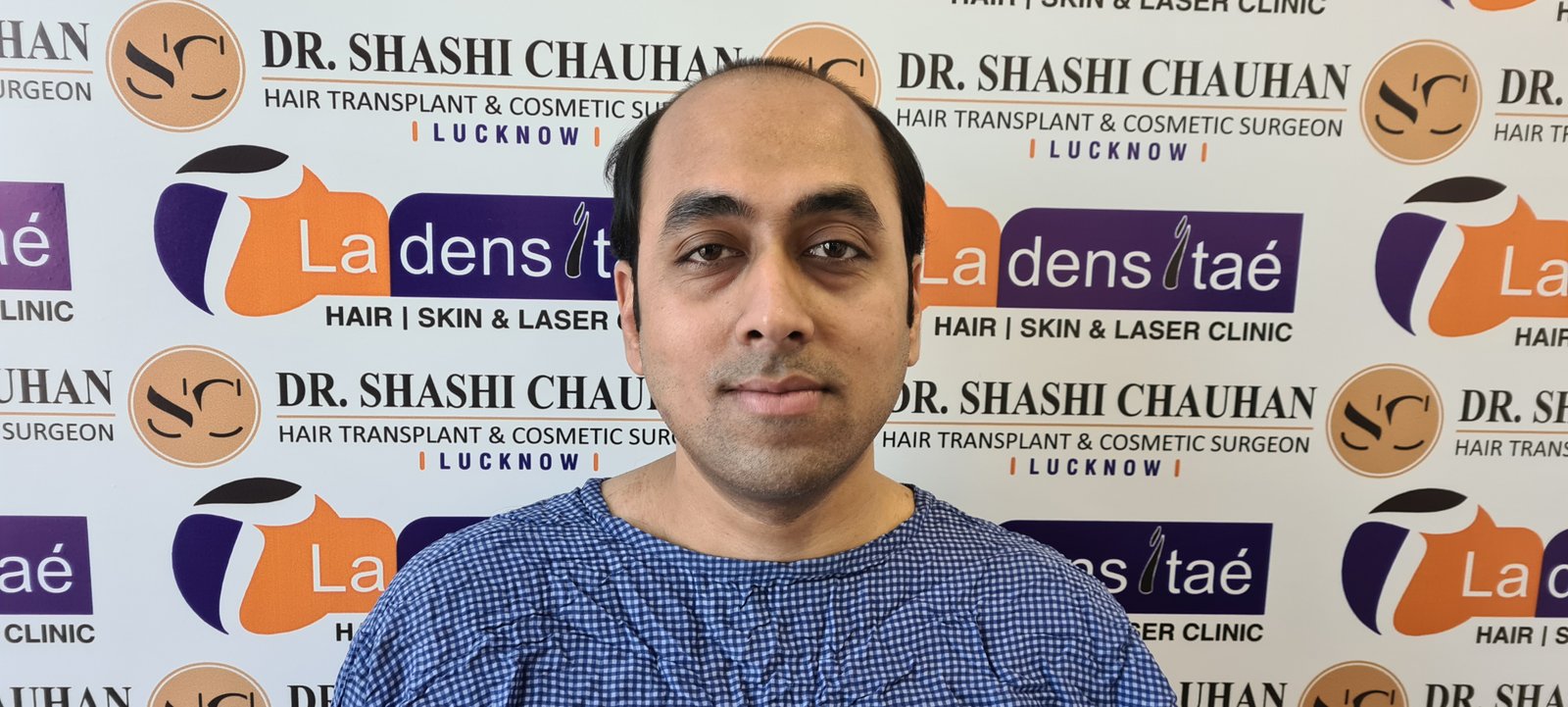 Utsav Aman Before Hair Transplant